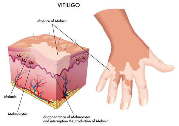 the cause of vitiligo.jpg