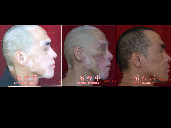 vitiligo on head and face .jpg