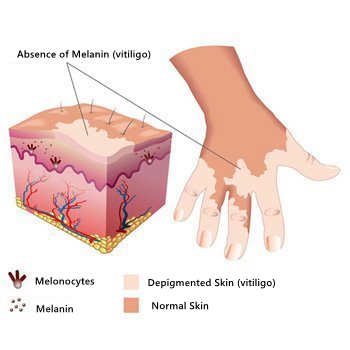 Vitiligo-Treatment-Stage350.jpg